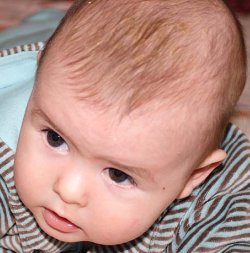 My baby's scalp with cradle cap